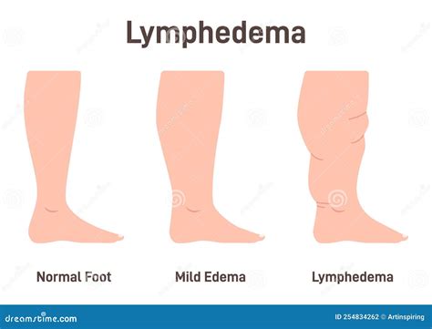 Lymphedema Stages. Lymphatic System Dysfunction Disease. Swollen Legs, Vector Illustration ...
