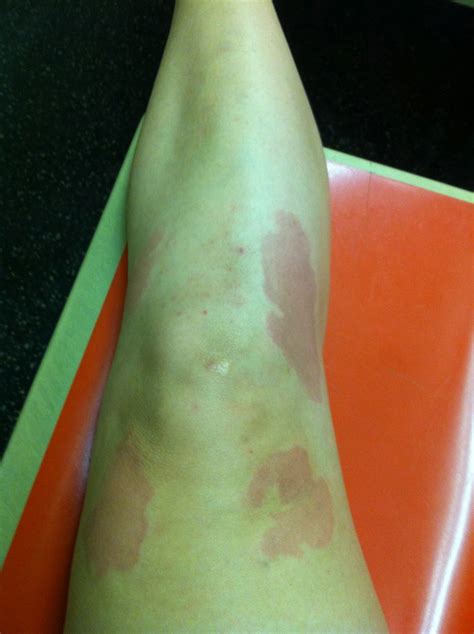 Ice Pack Burn Skin Discoloration Treatment at Douglas Wilder blog