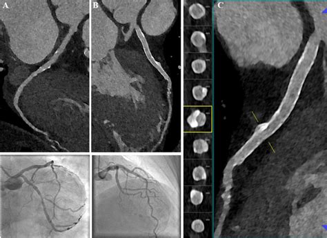 Photon-counting CT: Review of initial clinical results - European Journal of Radiology