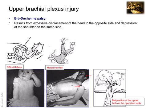 Surgical anatomy of nerve and vascular injuries in the upper limb | PPT