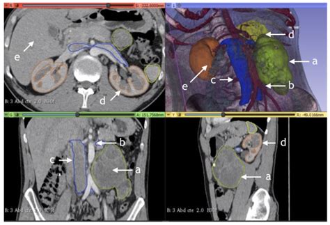 CT Rendering and Radiomic Analysis in Post-Chemotherapy Retroperitoneal Lymph Node Dissection ...