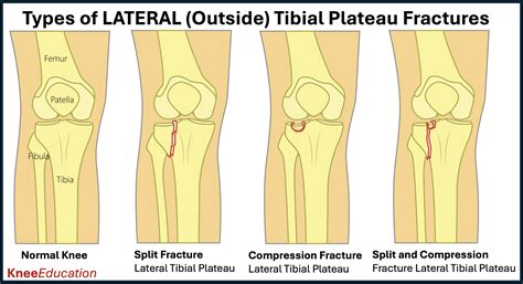 Tibial Plateau Fractures - Knee Education
