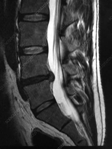 https://media.sciencephoto.com/image/c0394164/800wm/C0394164-Lumbar_Disc_Herniation%2C_MRI.jpg