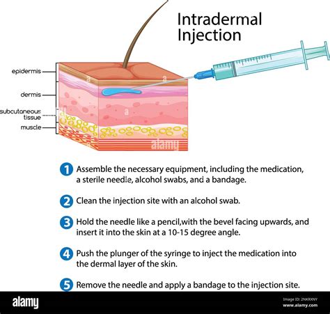Intradermal Injection with explanation illustration Stock Vector Image ...