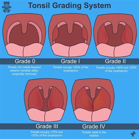 List The 4 Point Grading Scale For The Size Of Tonsils - Free Math ...