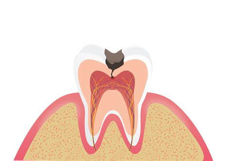 急性牙髓炎是如何引起的-京东健康