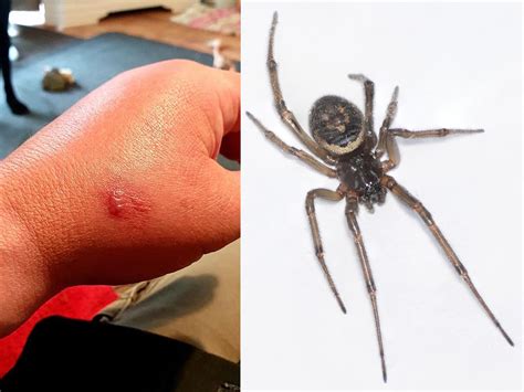 Black Widow Spider Bite Pictures