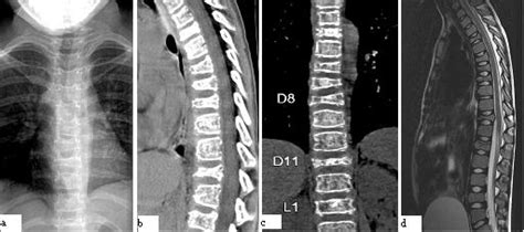 From initial common back pain in a child to final diffuse metastatic ...