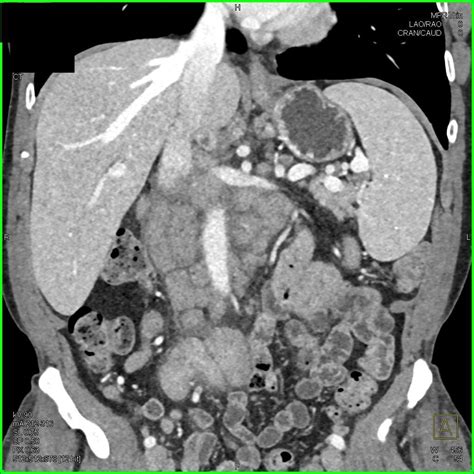 Lymphoma - Gastrointestinal Case Studies - CTisus CT Scanning