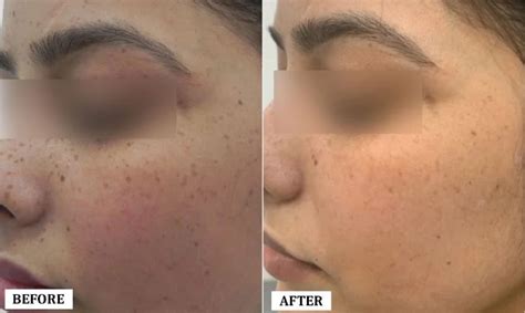 Best Clinic for Freckles Removal in Noida | Freckles Treatment in Noida