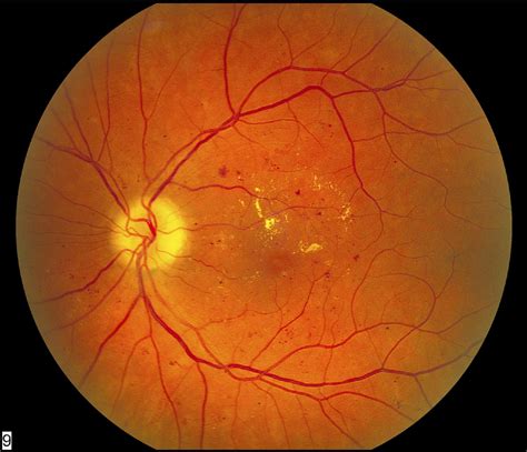 Diabetic Retinopathy: An Update on Treatment - The American Journal of ...