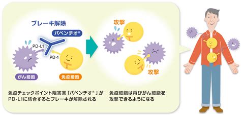 バベンチオ 尿路上皮癌 治療【患者向け】 | メルクバイオファーマ