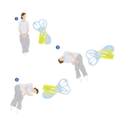 Positional vertigo | Symptoms & Treatment | hear.com India