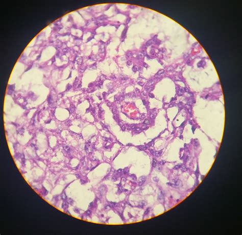 Pure yolk sac tumour, post-pubertal type, arising from cryptorchid testes | BMJ Case Reports