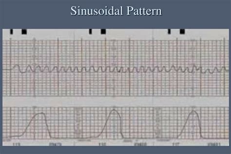 PPT - Fetal Heart Rate Monitoring PowerPoint Presentation, free ...