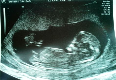 Baby Boy Ultrasound Pictures 12 Weeks at Alonzo Caraway blog