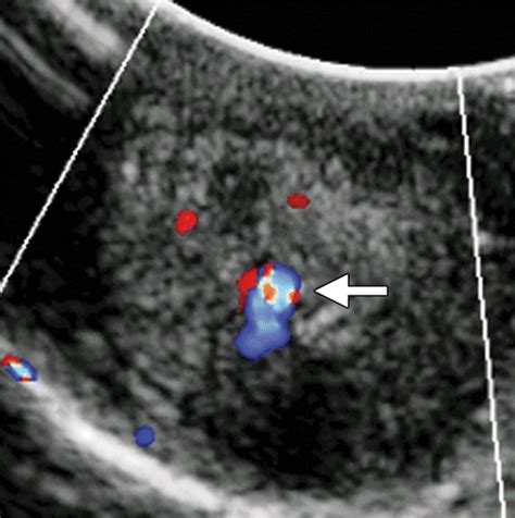 Bildergebnis für umbilical cord abnormalities ultrasound