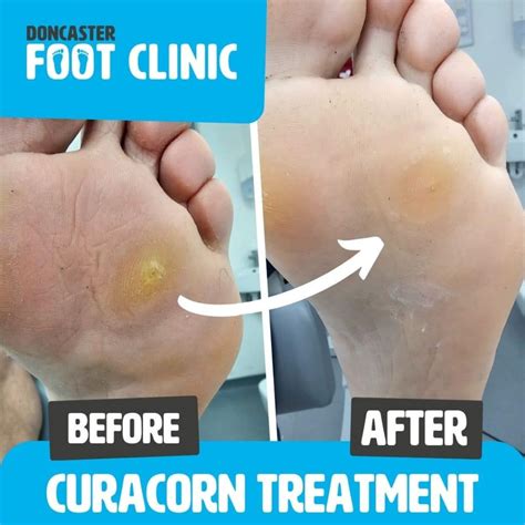 Treatments For Corns