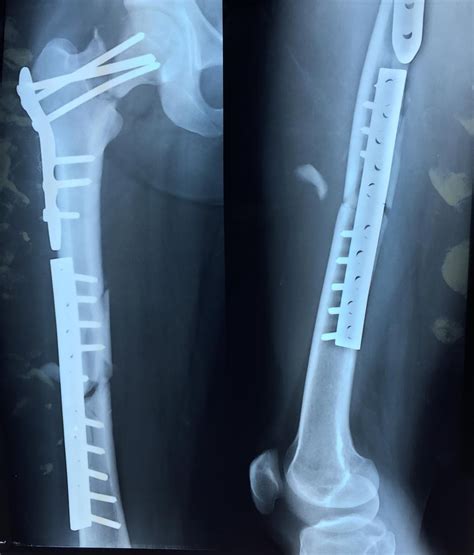 Femoral Neck Fractures - Trauma - Orthobullets