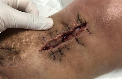 Removing Sutures Step by Step 的图像结果