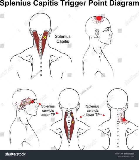 Splenius Capitis Trigger Point Vector Diagram Stock Vector (Royalty Free) 2423090339 | Shutterstock