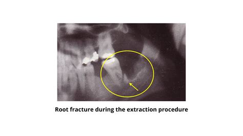Difficult Tooth Root Extraction 的图像结果