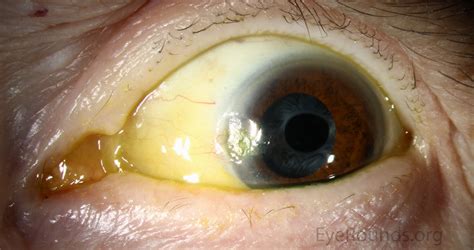 Atlas Entry - Corneal Delle