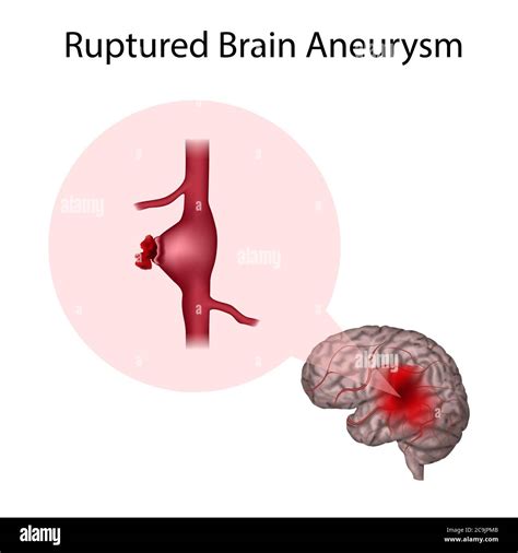 Ruptured brain aneurysm, illustration. An aneurysm is a blood-filled ...