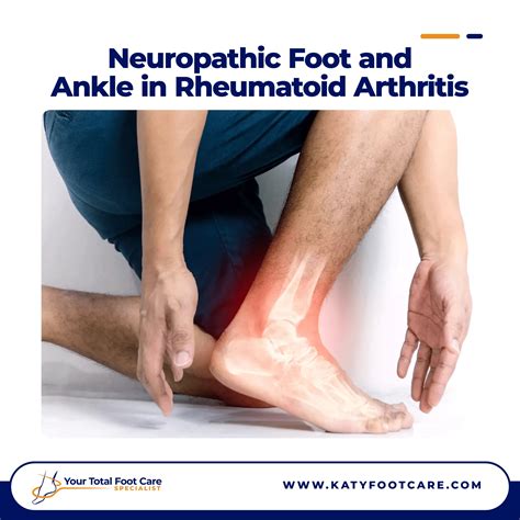 Rheumatoid Arthritis Feet Early Signs