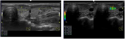 Shear Wave Elastography and Thyroid Imaging Reporting and Data System ...