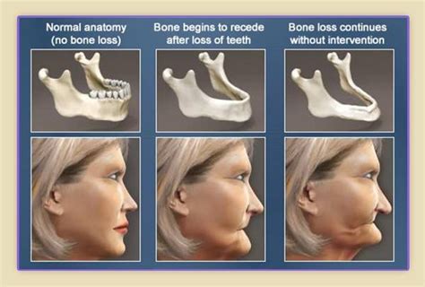jaw infection