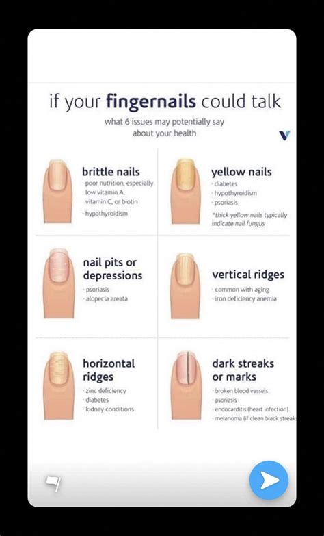 Normal black line under fingernail vs melanoma streak – Artofit