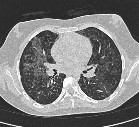 Hypersensitivity pneumonitis causes, symptoms, diagnosis, treatment & prognosis