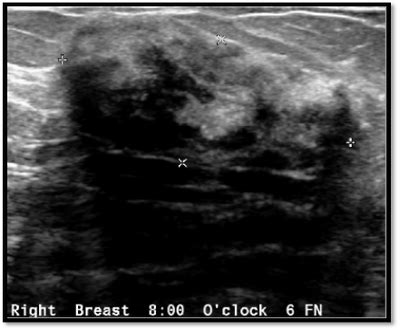 Breast Imaging Society, India