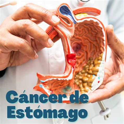 Cáncer De Estómago Y Estómago