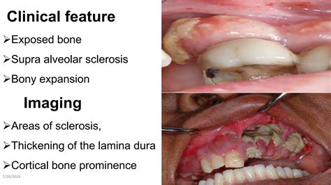 chap-4b osteomyelitis and osteoradionecrosis of jaws jaw.ppt