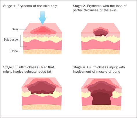 British Journal of Nursing - At a glance: pressure injuries