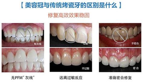 全瓷冠备牙时容易被牙医忽视的四个问题_预备_mm-_边缘