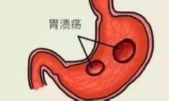 胃溃疡的食疗方法_胃溃疡吃什么好_苹果绿