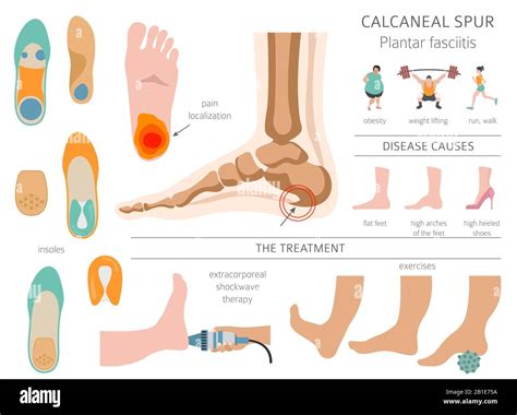Calcaneal Spur Treatment