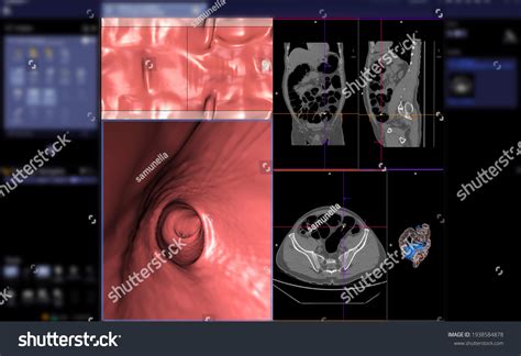 Ct Colonography Ct Scan Colon Axial Stock Illustration 1938584878 | Shutterstock