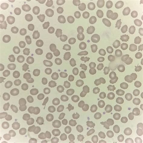 Burr Cells (Echinocytes): Hematology Bench & MLS Study Guide
