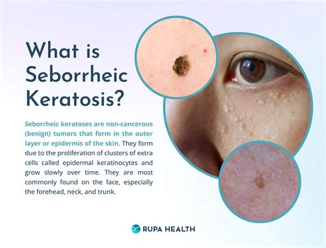 A Functional Medicine Approach to Seborrheic Keratosis