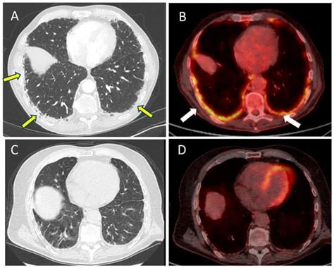 Lung Toxicity Occurring During Enfortumab Vedotin Treatment: From a ...