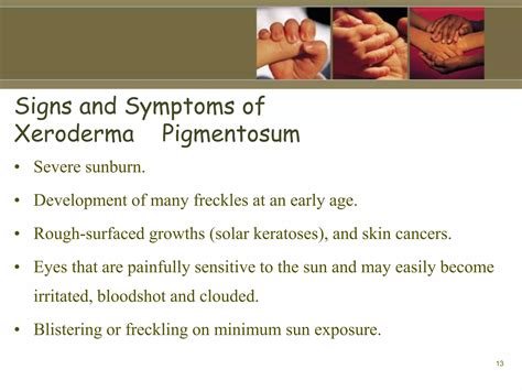 Symptoms Of Xeroderma Pigmentosum