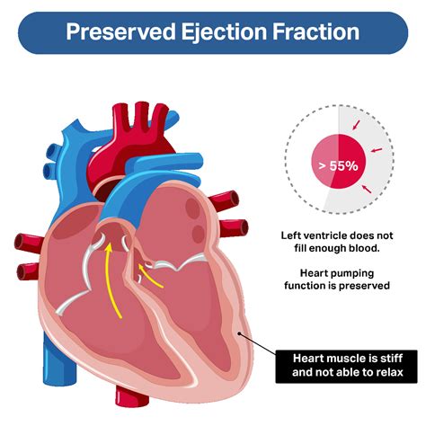 Ejection Fraction Biplane Meaning at Rebecca McKinney blog
