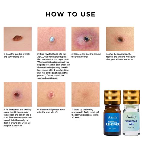 Azally Mole Corrector & Skin Tag Remover Cream with Repair Gel, Remove ...