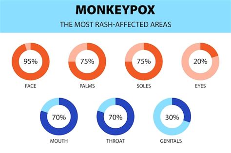 Apenpokkenvirus infographic Diagram van de meest door huiduitslag ...