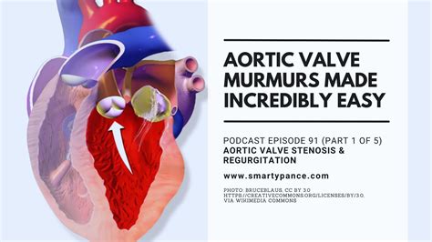 Podcast Episode 91: Cardiac Murmurs Made Incredibly Easy (Part 1 of 5) - Aortic Stenosis and ...