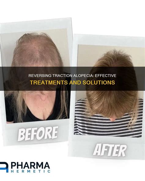 Reversing Traction Alopecia: Effective Treatments And Solutions | ShunSalon